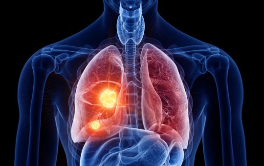 Co to jest zatorowość płucna? Objawy, przyczyny i leczenie zatorowości płucnej
